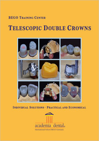 Telescopic double crowns: Individual solutions – practical and economical