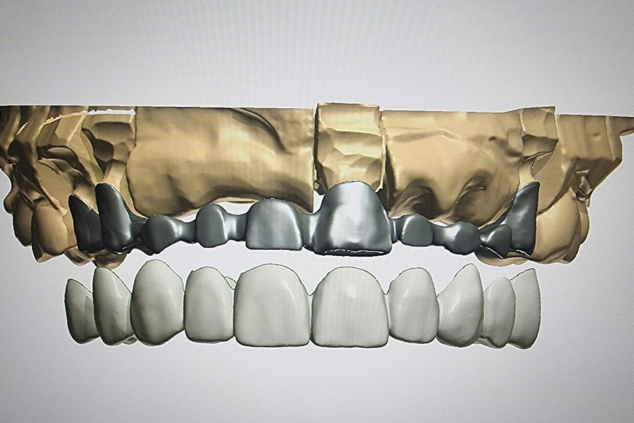 std_1K_SmartVeneering_3D-Anwendung