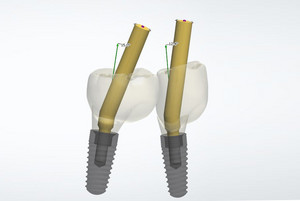 From now on, BEGO offers angulated screw channels for one-piece bridge and bar restorations in which the alignment of the screw access channel within the prosthetic restoration can be individually selected from 0° to 20° to the implant position. 