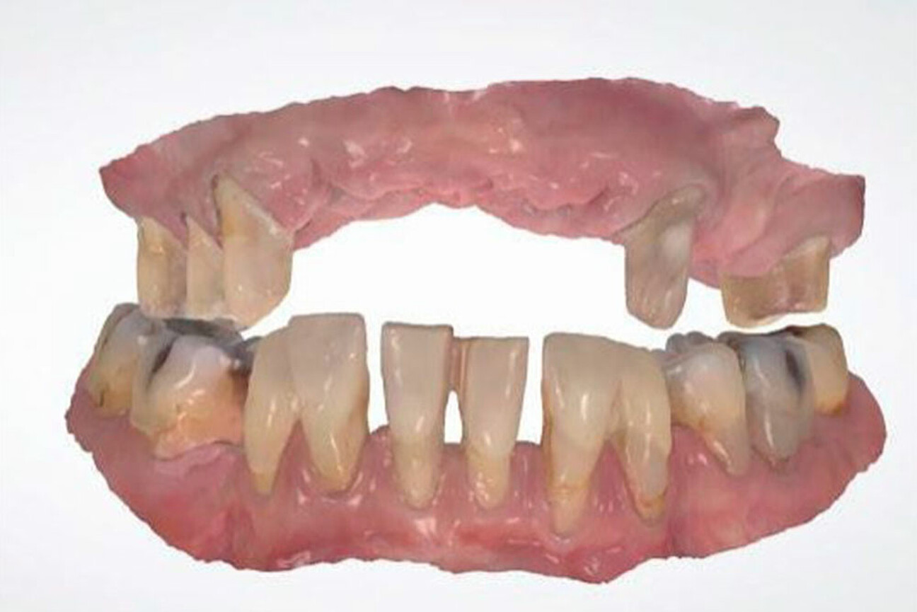 std_1K_SmartVeneering_Therapie