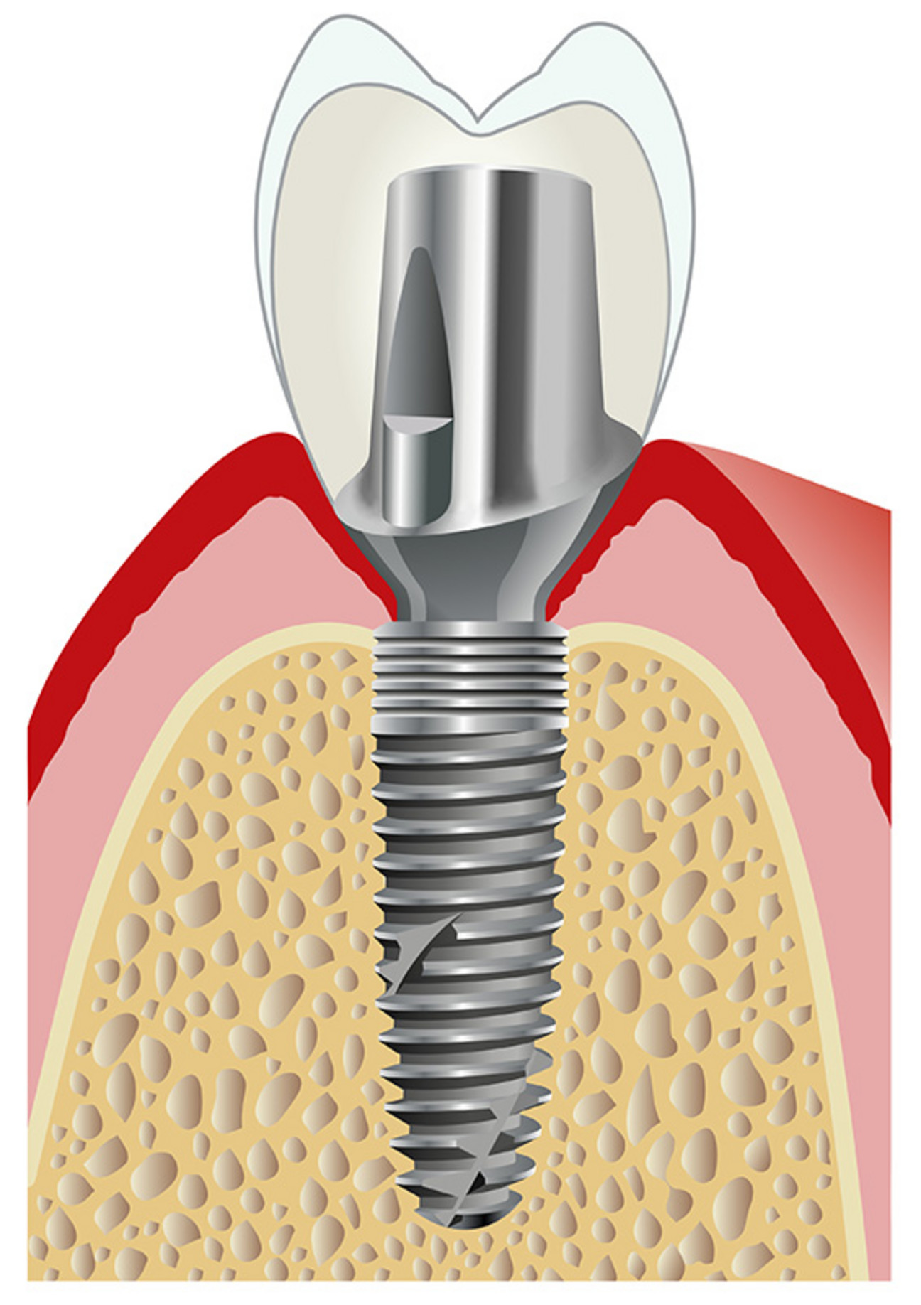 RSX Implant with PS-Line abutment