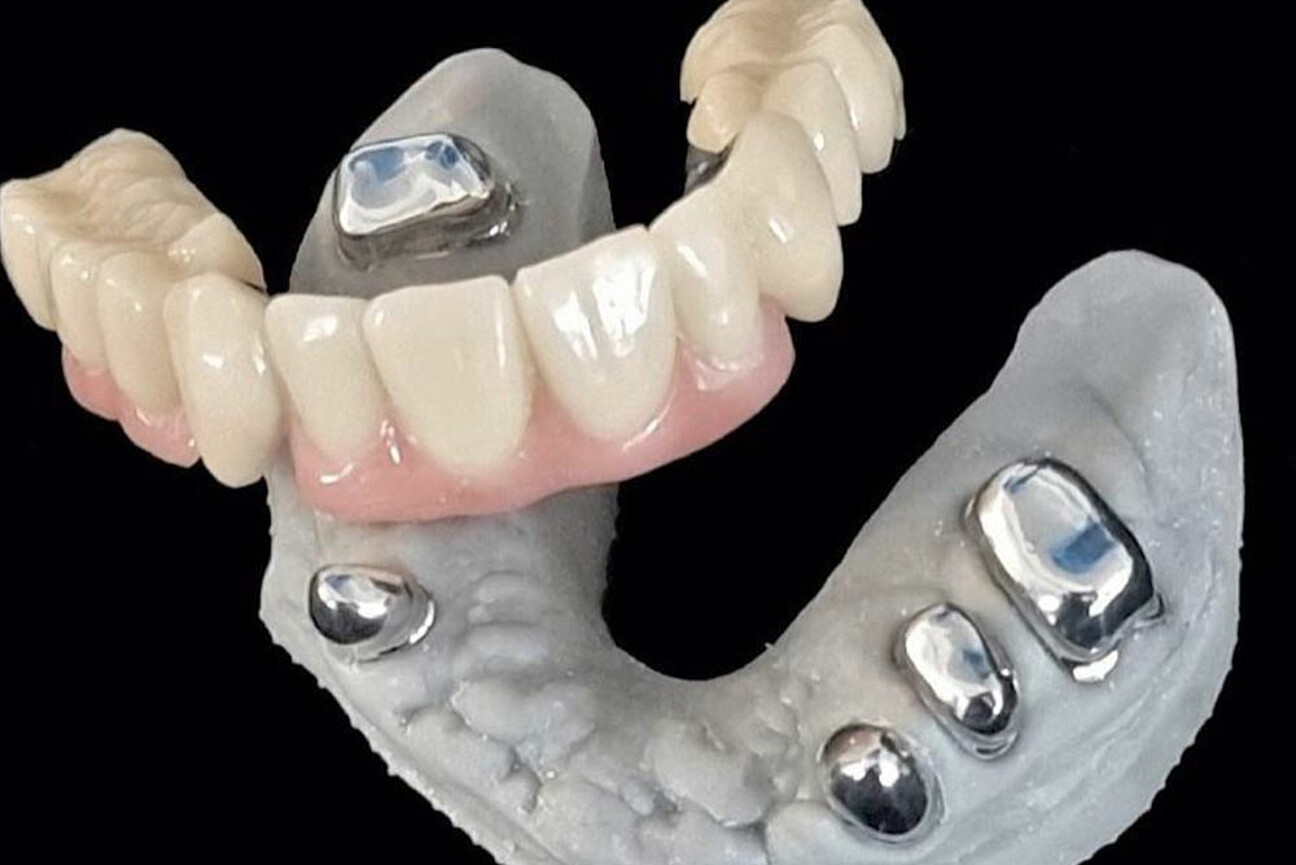 std_1K_SmartVeneering_Ergebnis