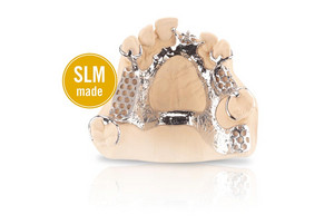 Removable partial denture frameworks made of WIRONIUM® RP are characterized by their high accuracy of fit.