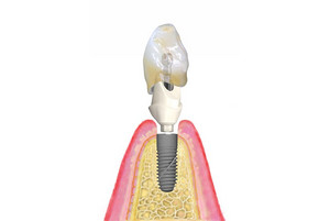 Exploded view of a BEGO Semados® restoration