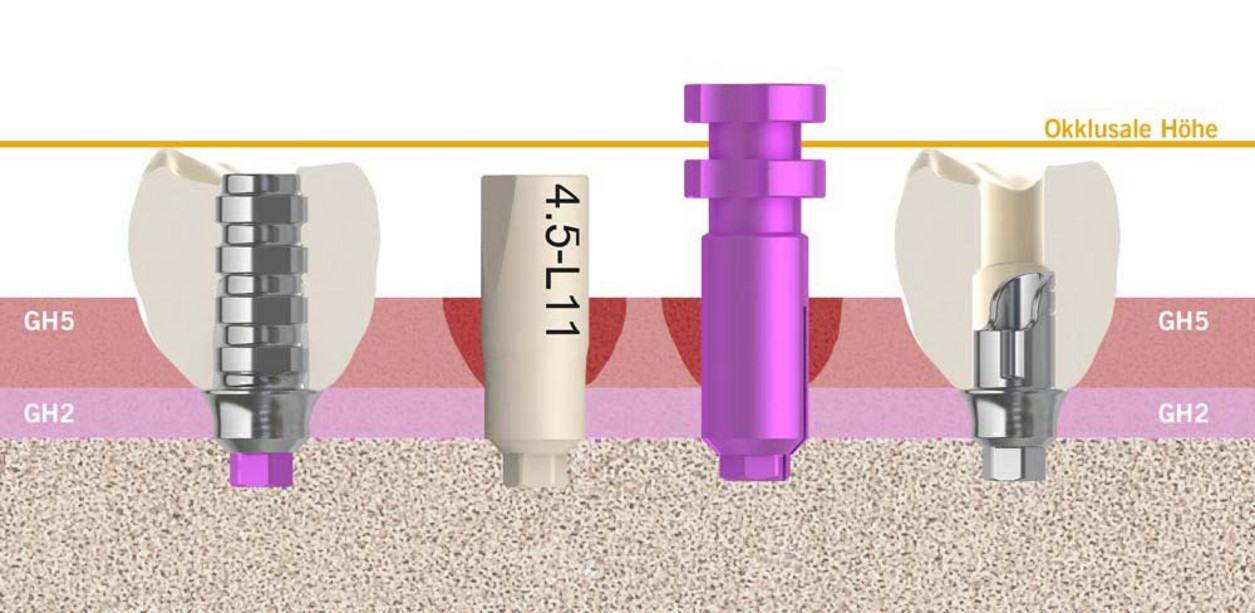 img700_prothetischer-workflow-02