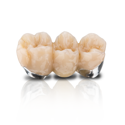 Smart Veneering with VarseoSmile Crown plus – Simply intelligent!