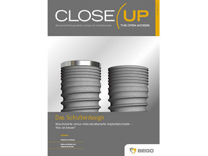 Die neue CloseUp Ausgabe – Das Schulterdesign - Maschinierte versus mikrostrukturierte Implantatschulter – Was ist besser?