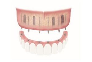 Schematic diagram of a provisional restoration using BEGO Semados® Provisional Implants