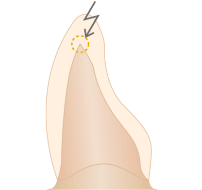 Avoidance of sharp edges