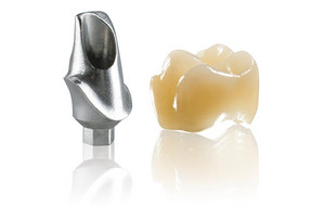 Individuelle Abutments auf Basis der Implantatplanung