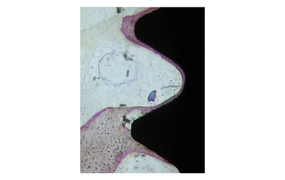 Histology, 2 weeks post-op. Incipient new bone formation on the implant with high osteoblast activity (courtesy of Prof. Dr. Adriano Piattelli, Chieti, Italy)