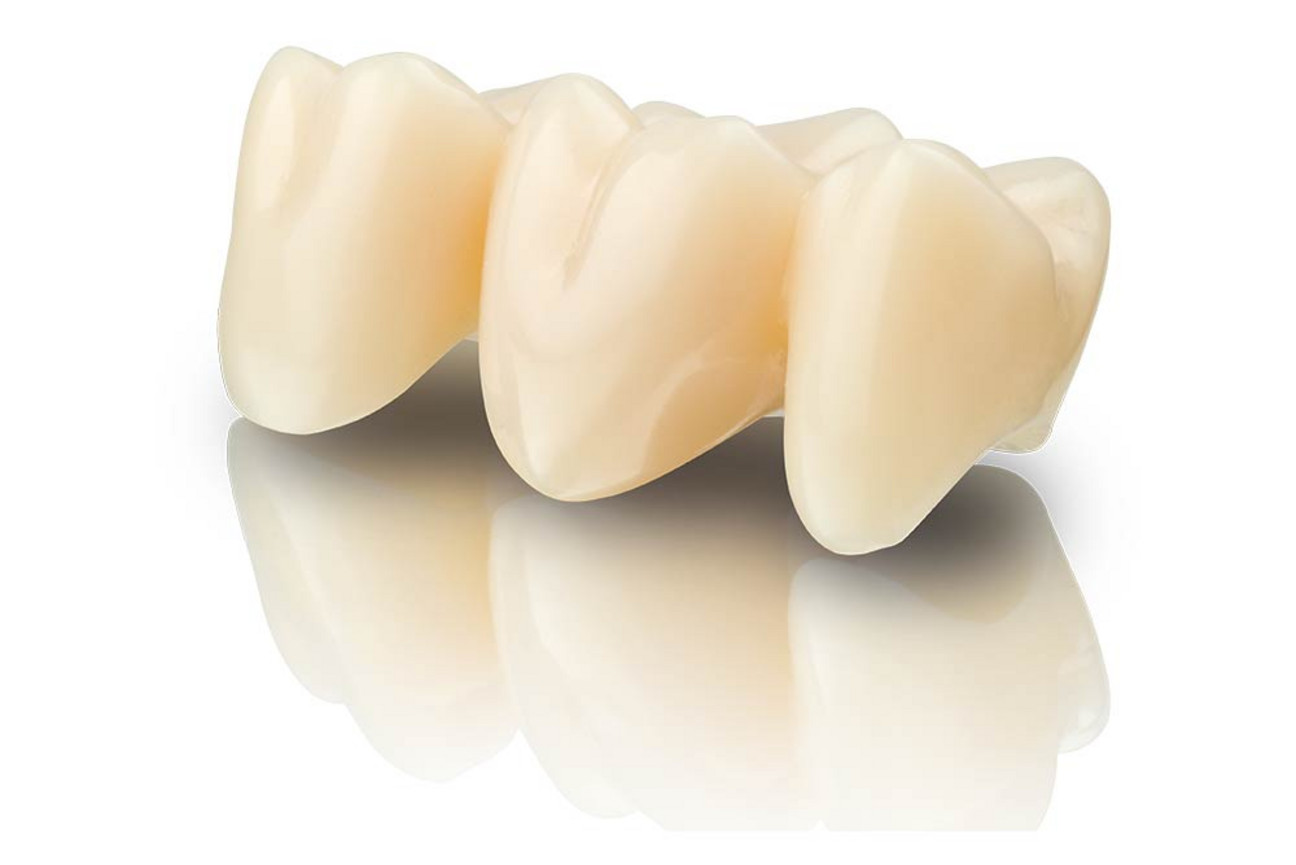 VarseoSmile® TriniQ® – The tooth-colored, ceramic filled hybrid material for 3D printing of permanent crowns and bridge restorations, inlays, onlays, veneers and prosthetic teeth