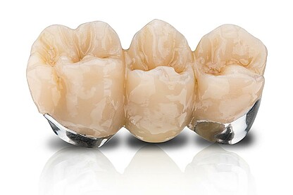 std_1K_SmartVeneering_Bruecke-Title