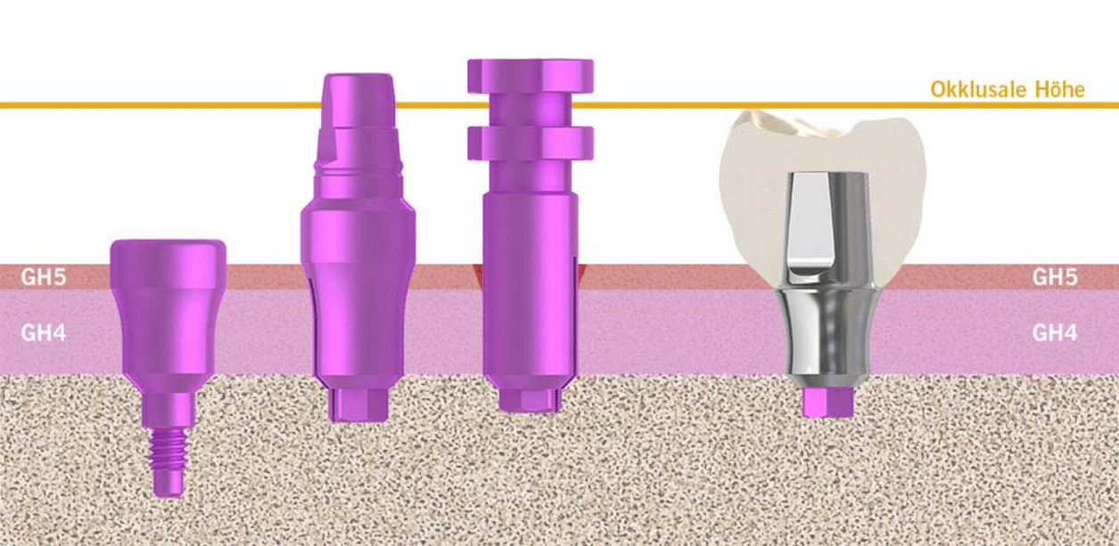 img700_prothetischer-workflow-01