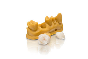 VarseoSmile Crown – the first Varseo material for the 3D printing of permanent single crowns is characterized by its outstanding strength, low water absorption and high color stability