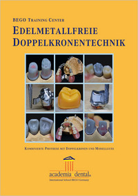 Edelmetallfreie Doppelkronen – Kombinierte Prothese mit Doppelkronen und Modellguss