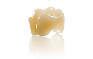 A single crown produced with BEGO PMMA Multicolor.