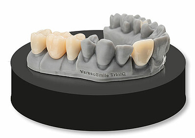The high strength of VarseoSmile ®TriniQ ®enables the reliable fabrication of permanent three-unit bridges