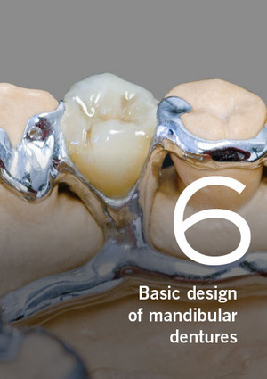 Partial dentures – Basic design of mandibular dentures, Part 6