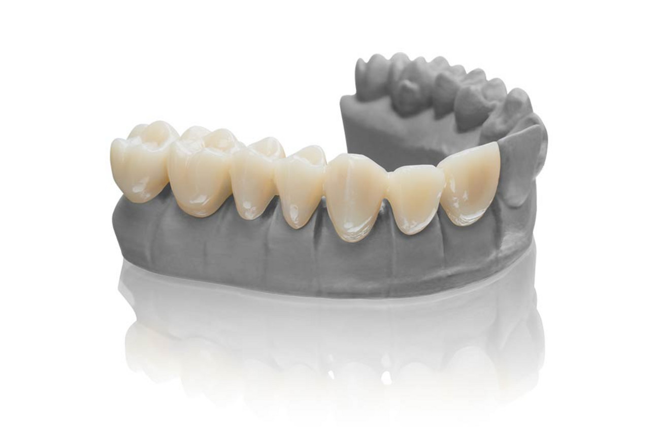 VarseoSmile Temp – The tooth-colored resin for 3D printing of temporary crown and bridge restorations, inlays, onlays, and veneers 