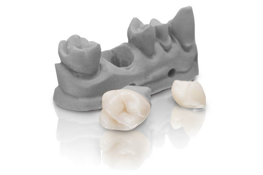 VarseoSmile Crown plus – The tooth-colored, ceramic filled hybrid material for 3D printing of permanent single crowns, inlays, onlays and veneers 