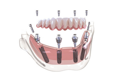 MultiPlus Versorgung
