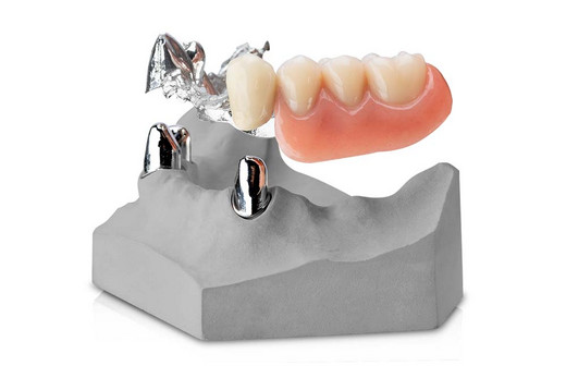 WIRONIUM® RP Hybrid Partial Denture Frameworks with telescopes